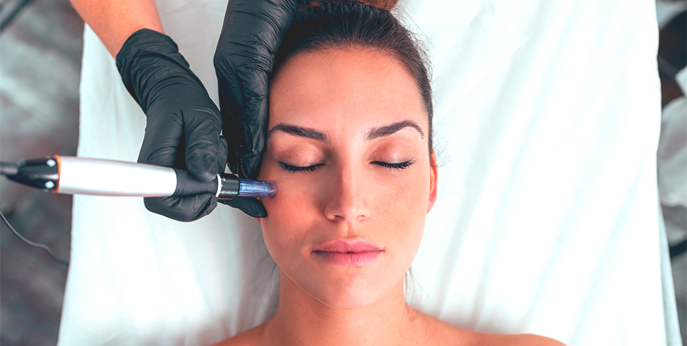 Microneedling